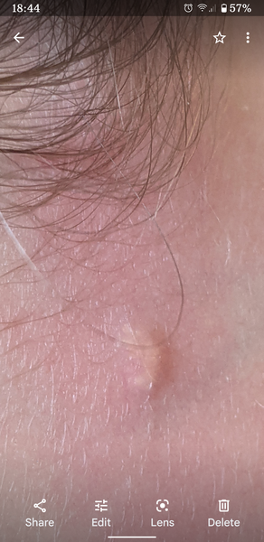 Strange spot on cheek