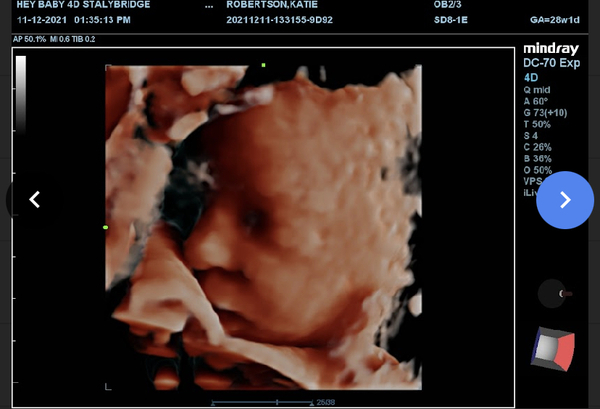 11 days late -BFN! Please someone give me a success story.