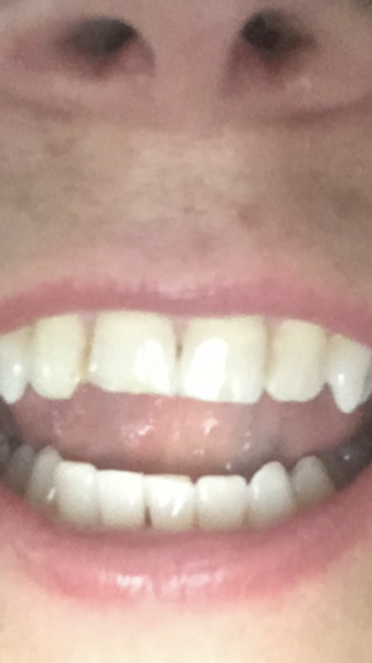 Dental veneers?