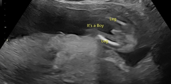 Boy gender scan