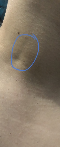 Dimple/Indentation on neck- Pic attached