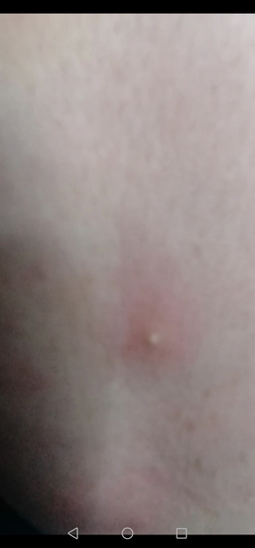Weird v sore spot things