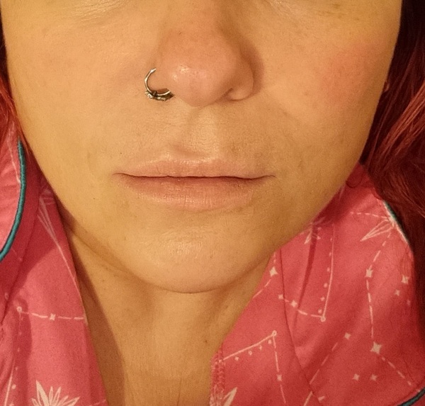 Has anyone had fillers for jowls and marionettes?