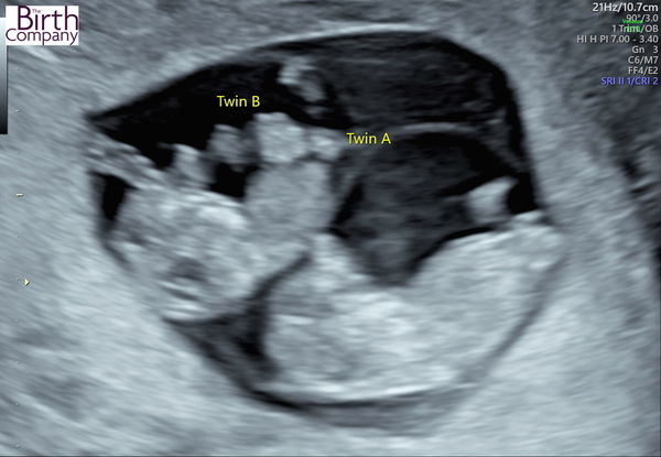 IVF Graduates due Summer 2022