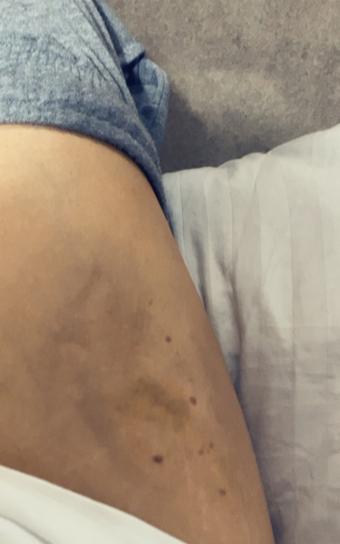 Fragmin injections - bleeding after? Or bed bugs??