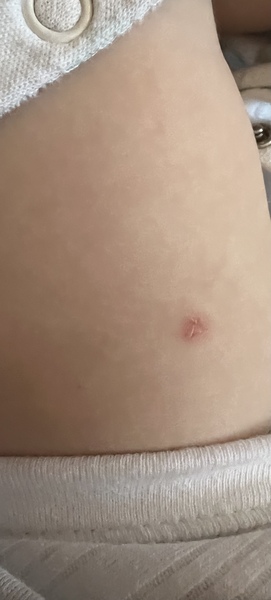 Is this chicken pox ??