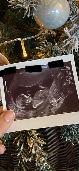 12 week scan, boy or girl?