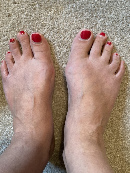 To fucking HATE bunions