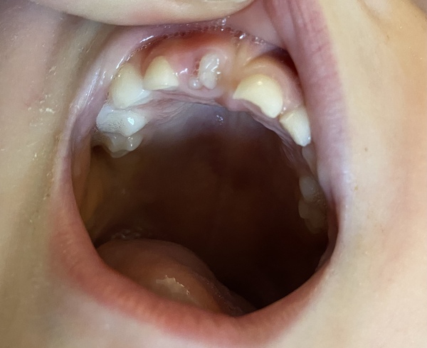 To be upset over DC tooth?