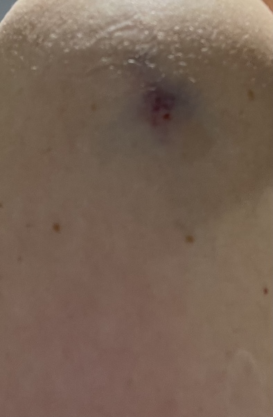 Covid jab - is this normal