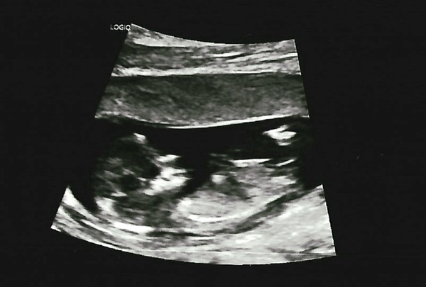 Nub theory - boy or girl?