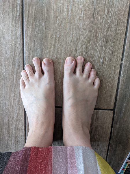 To fucking HATE bunions
