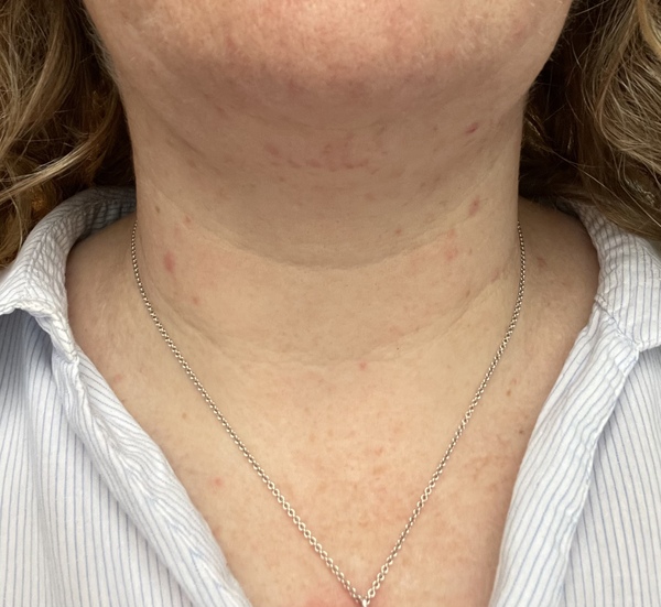 Electrolysis stories