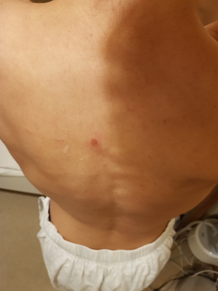 Should I be worried about this sore on my back?