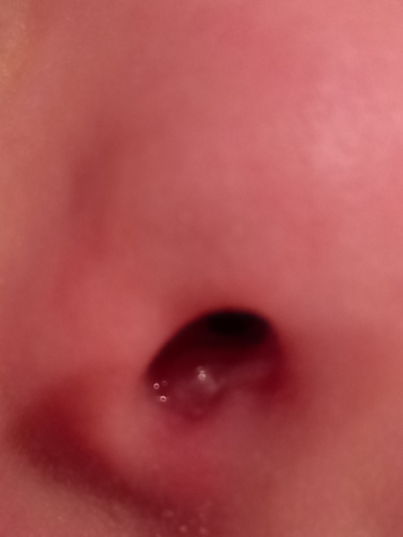 Anyone know what this is? Pic of growth up child's nose