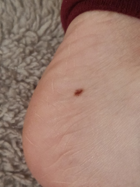 Do GPs actually examine suspicious moles?