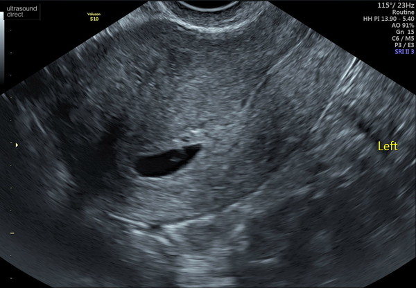 No fetal pole at 6+3