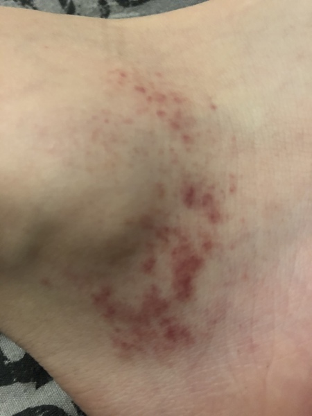 Rash