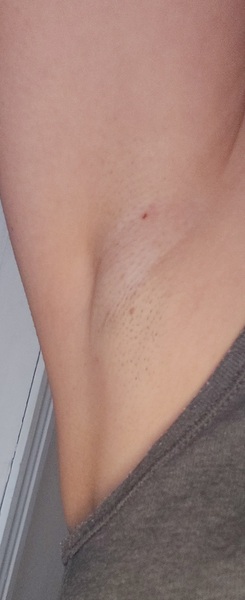 Swelling in armpit photo attached!