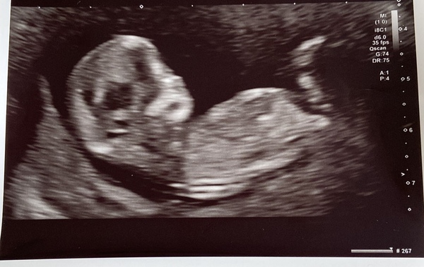 12 Week Ultrasound - Flat Back of Head?