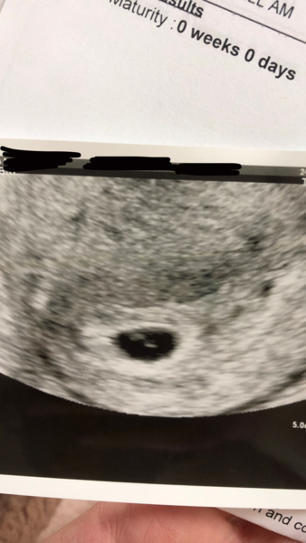 Early pregnancy scan