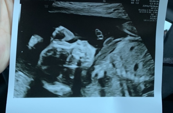 Anyone else 5 weeks pregnant?