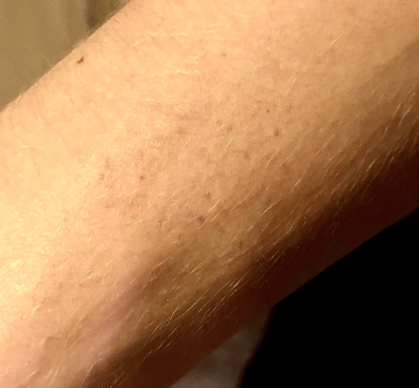 Petechiae recurrent