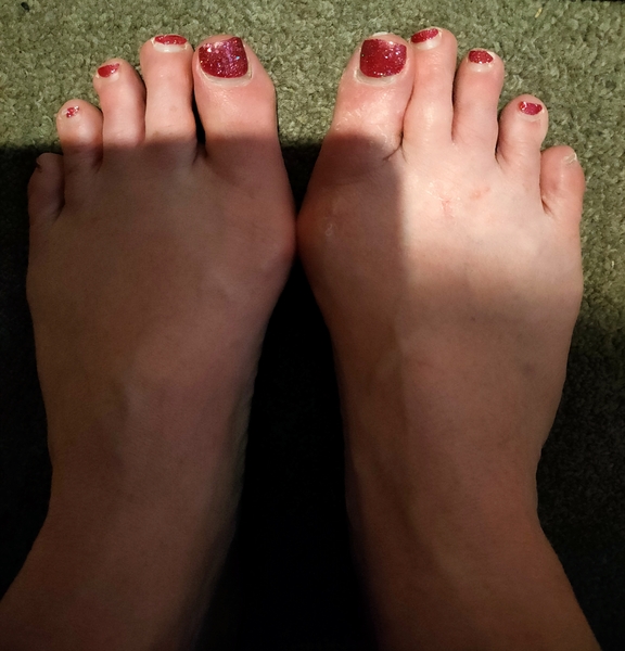 To fucking HATE bunions