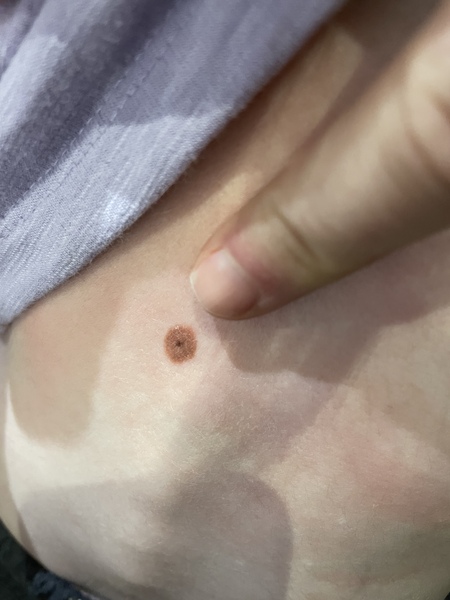 What kind of mole is this (pic included)?