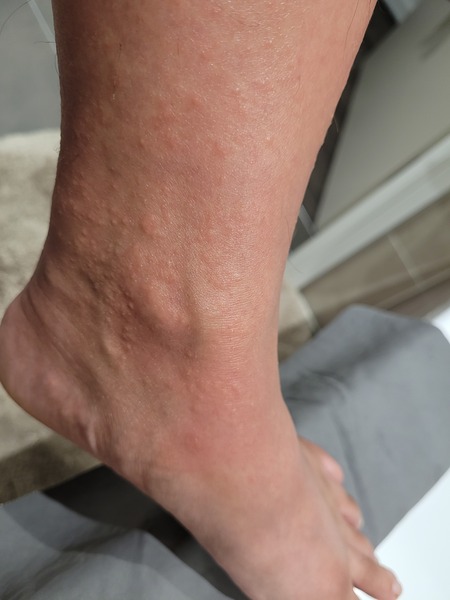 37 Weeks Rash help