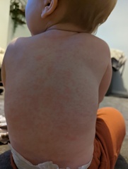 10 month old rash