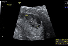Pregnancy after miscarriage