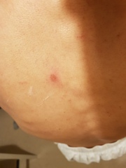 Should I be worried about this sore on my back?