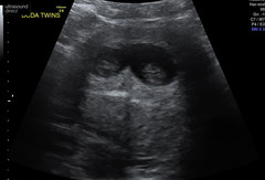 Pregnancy after miscarriage