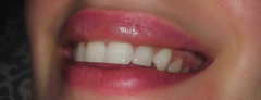Please help with lip filler advice