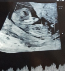 Nub-less baby :-/   (Where's the frickin's nub?!)