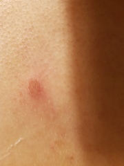 Should I be worried about this sore on my back?