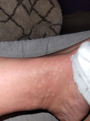 37 Weeks Rash help