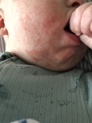 Rash