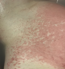 37 Weeks Rash help