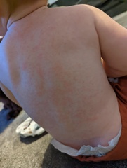 10 month old rash