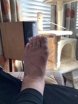 To fucking HATE bunions