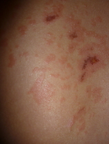 Nasty Rash
