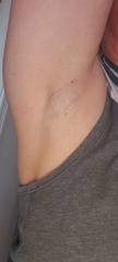 Swelling in armpit photo attached!