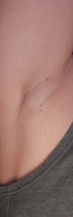 Swelling in armpit photo attached!