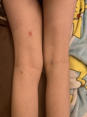 What is this rash in my son? (pics incl)