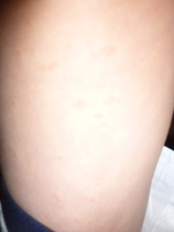 Nasty Rash