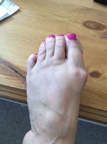 To fucking HATE bunions