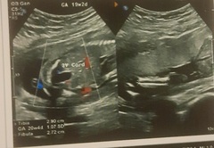 Nub-less baby :-/   (Where's the frickin's nub?!)