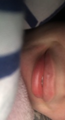 Please help with lip filler advice